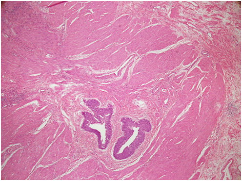urothelial carcinoma